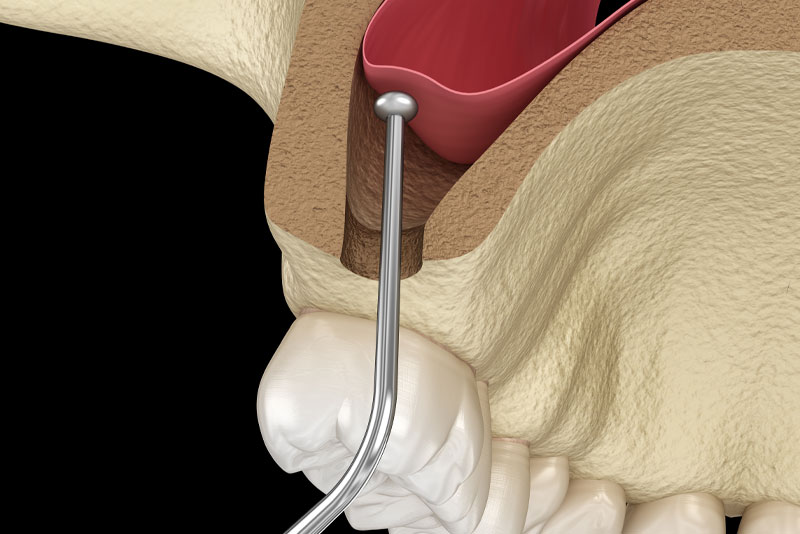 Artist rendering of the sinus lift procedure