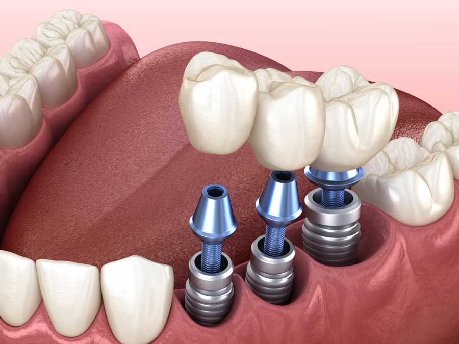 a diagram of dental implants being placed