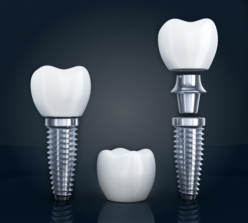the three different parts that make up a dental implant